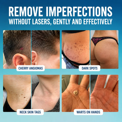 Anti-Skin Tag Roller
